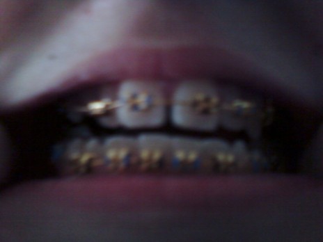 I just got my braces.