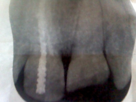 Another RootCanal.