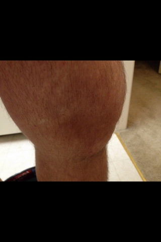 My brother's swollen leg